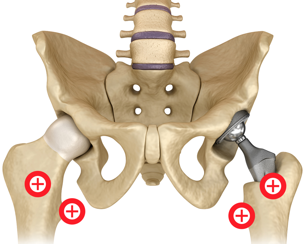 hip replacement surgery rehab physio information in biggleswade